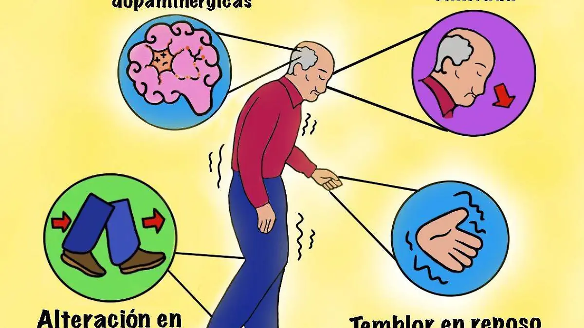 Figura 1 El Parkinson es multifactorial lo cual explica su variedad sintom tica.